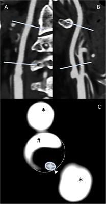 CT Angiography Manual Multiplanar Vessel Diameter Measurement vs. Semiautomated Perpendicular Area Minimal Caliber Computation of Internal Carotid Artery Stenosis